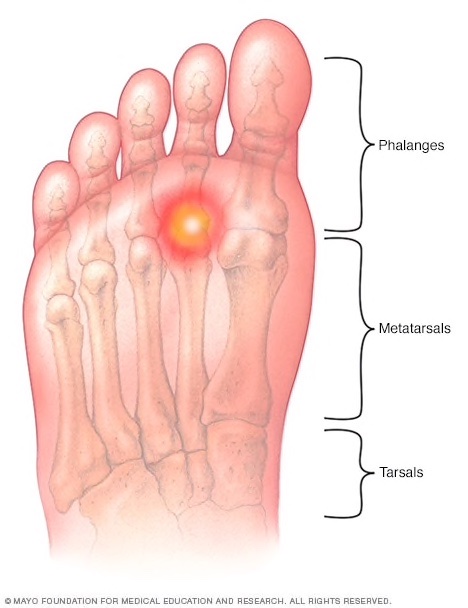 Metatarsalgia Or Foot Pain The Orthobiologic Clinic