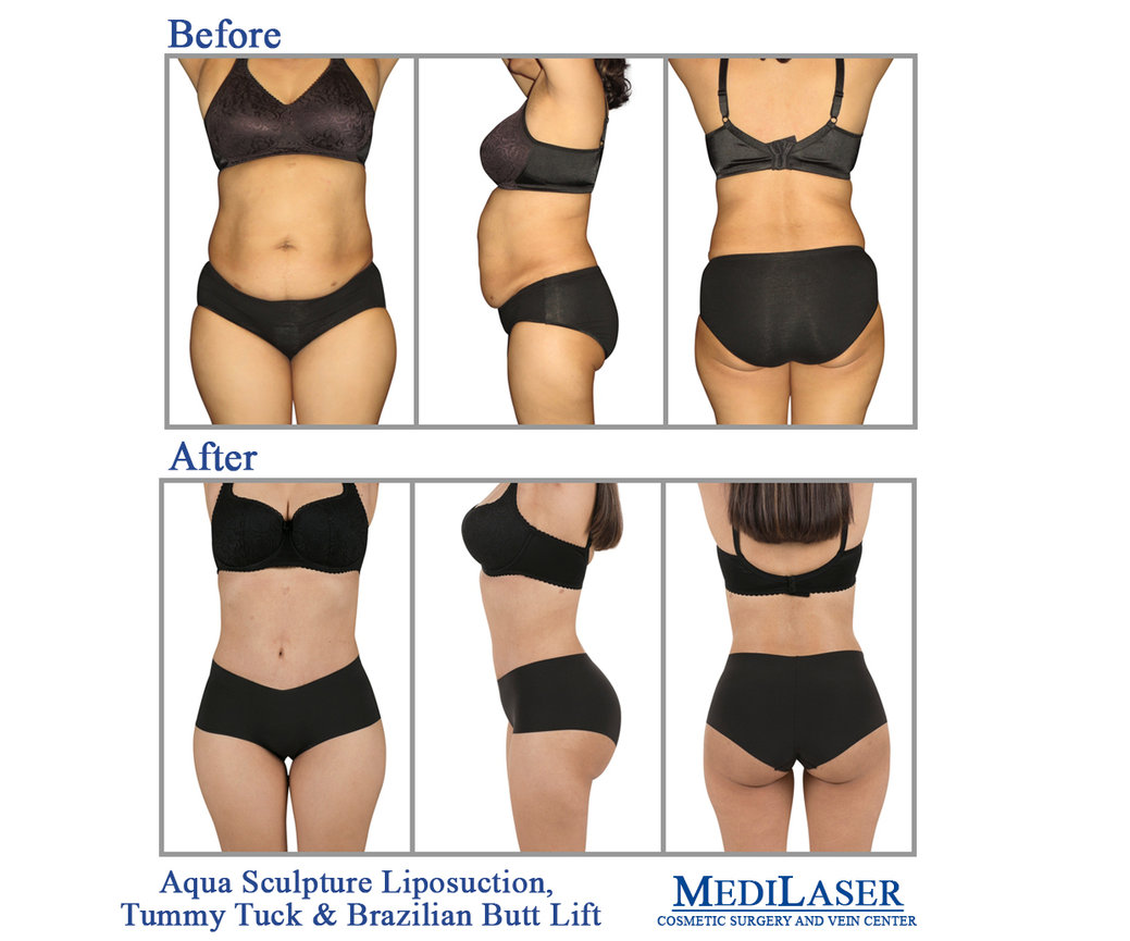 Mothers-Day-Mommy-Makeover-Mom-Bod - Medilaser Surgery and Vein Center