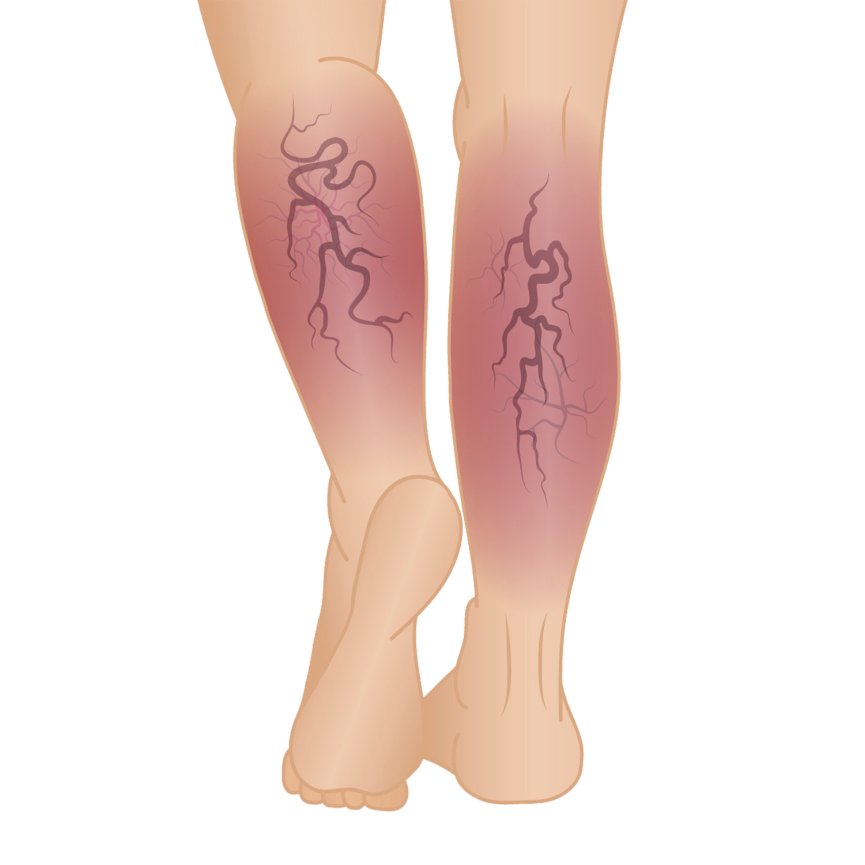 Chronic Venous Insufficiency: Causes, Symptoms and Treatment