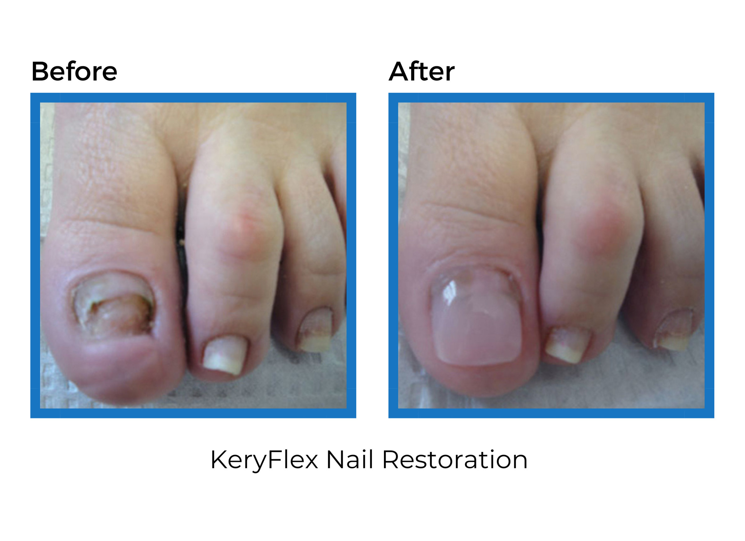 Keryflex™ Nail Restoration System - Foot & Ankle Centers Of Frisco And 