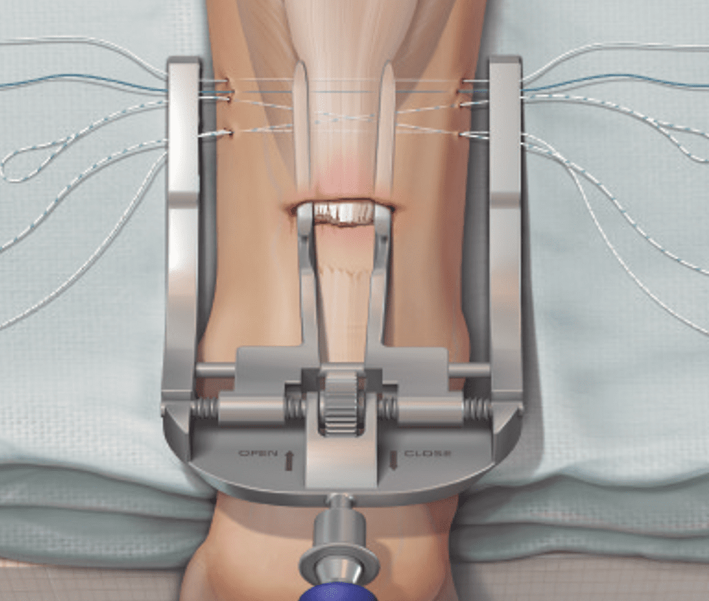 Achilles Tendon Rupture Foot & Ankle Centers of Frisco and Plano