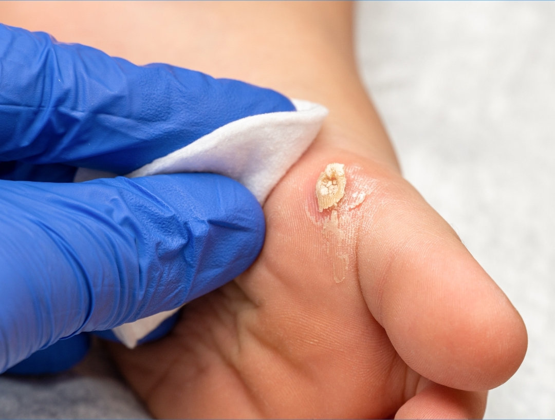 Treating Foot Wart