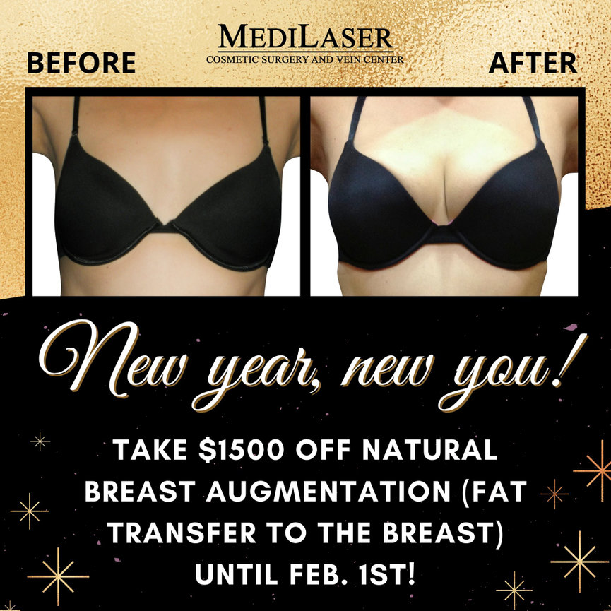 Breast Augmentation Before and After - Medilaser Surgery and Vein Center