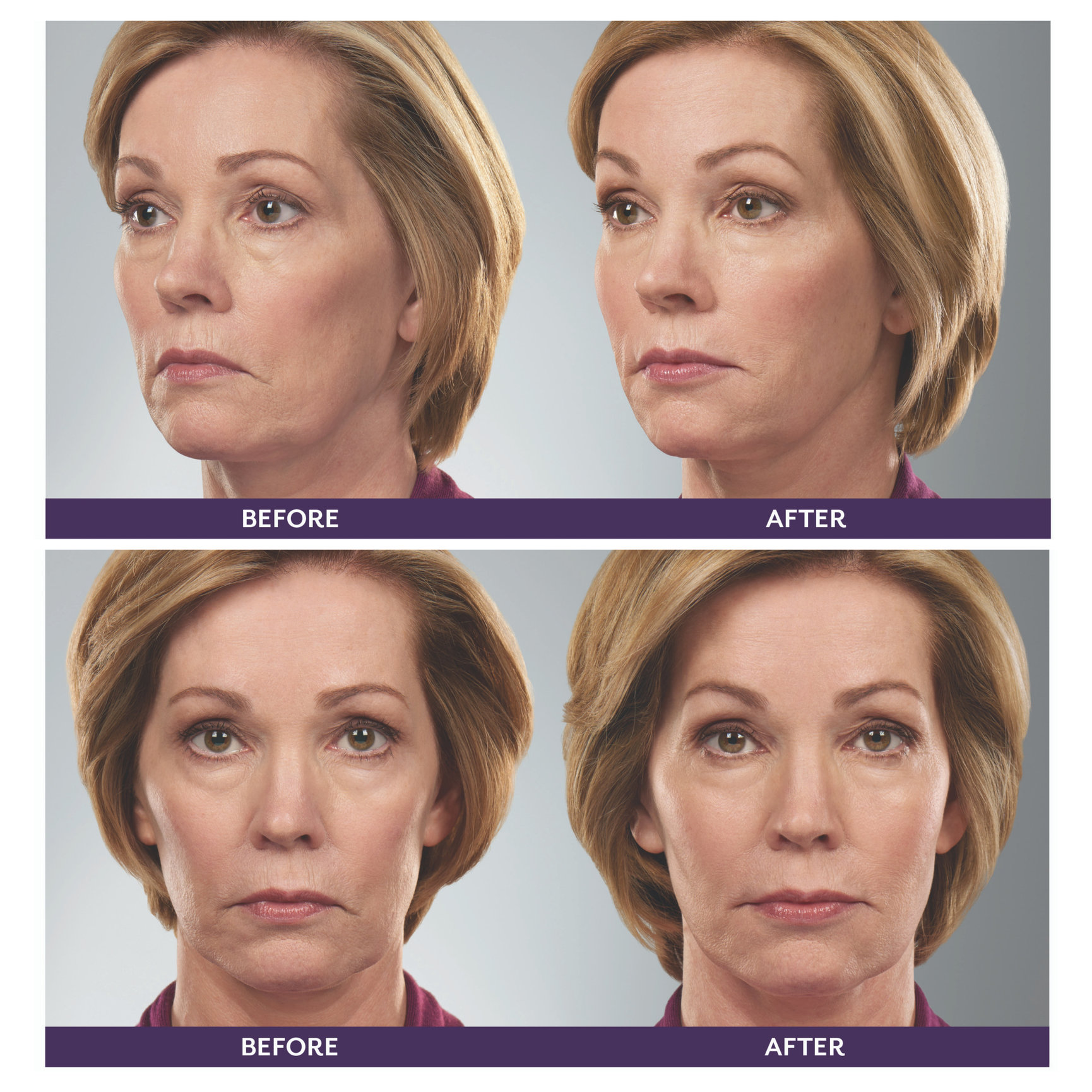 Facial Filler Before and After - Feel Ideal 360 Med Spa - Southlake, TX