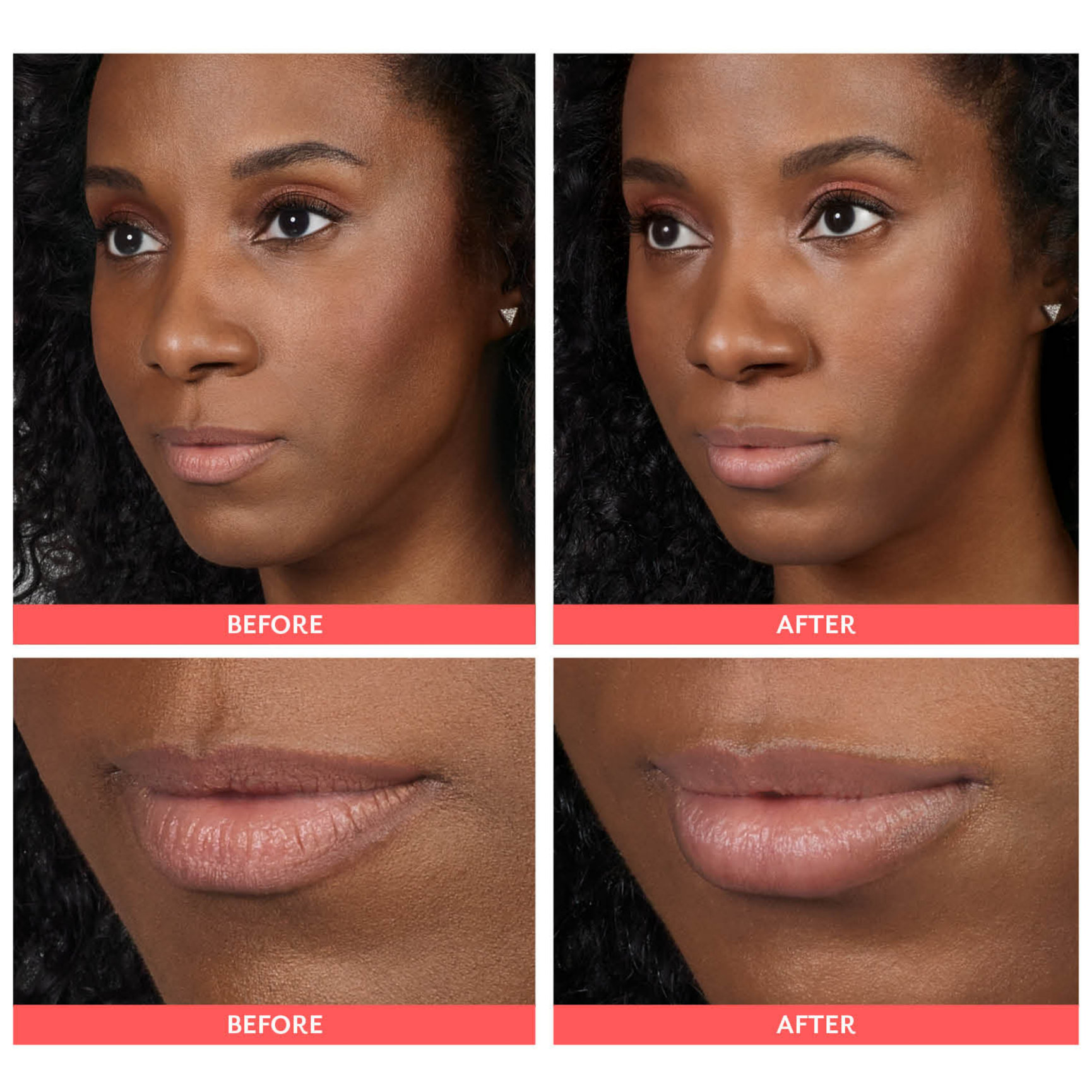 Lip Filler Before and After Feel Ideal 360 Med Spa Southlake, TX