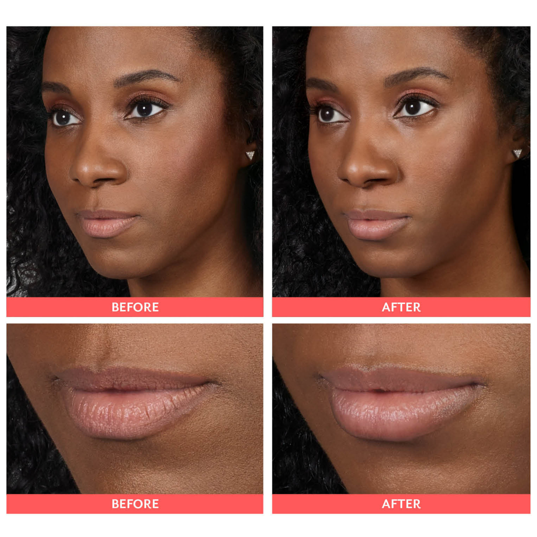 Lip Filler Before And After Feel Ideal 360 Med Spa Southlake Tx 0789