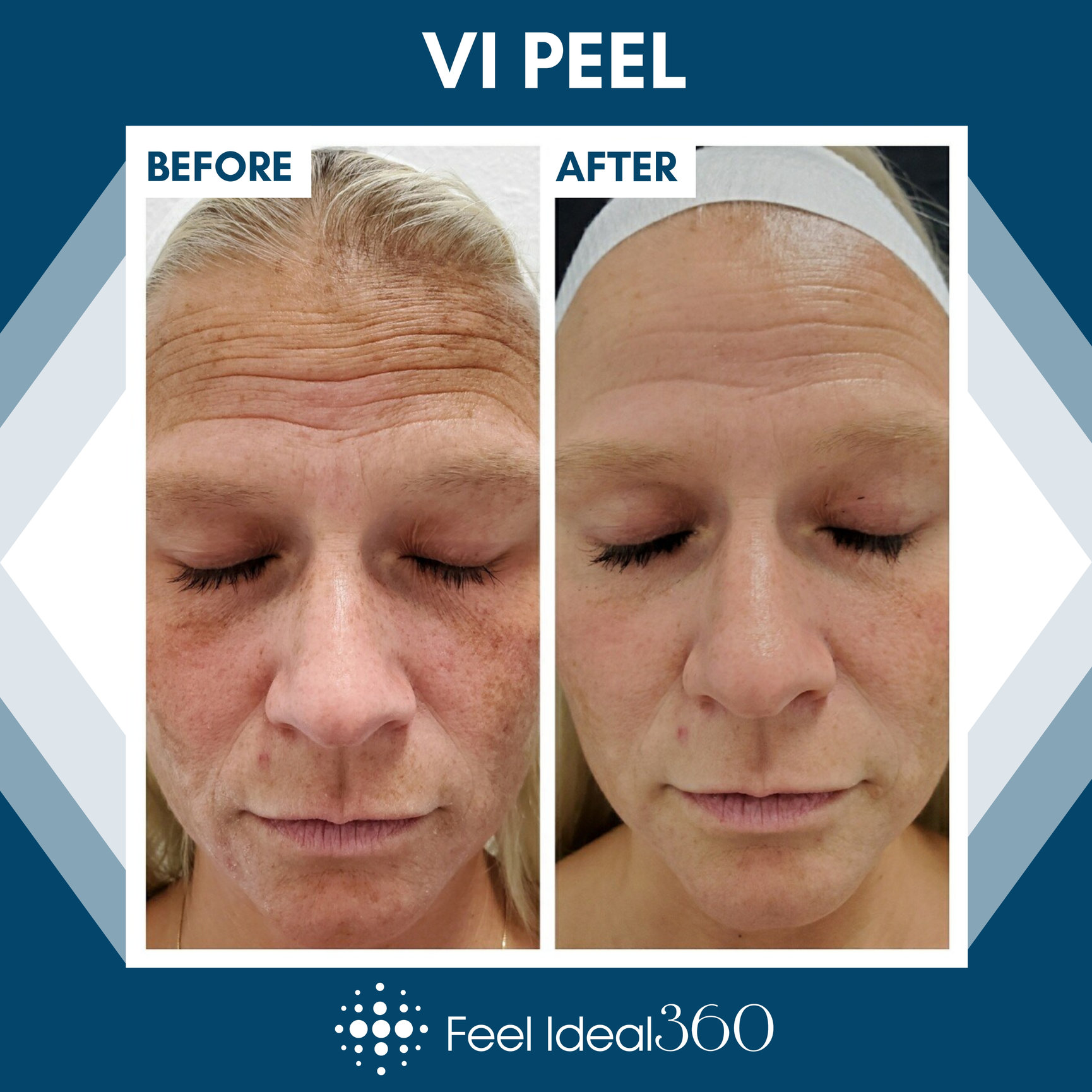 Vi Peel Before And After Feel Ideal 360 Med Spa Southlake Tx 9475