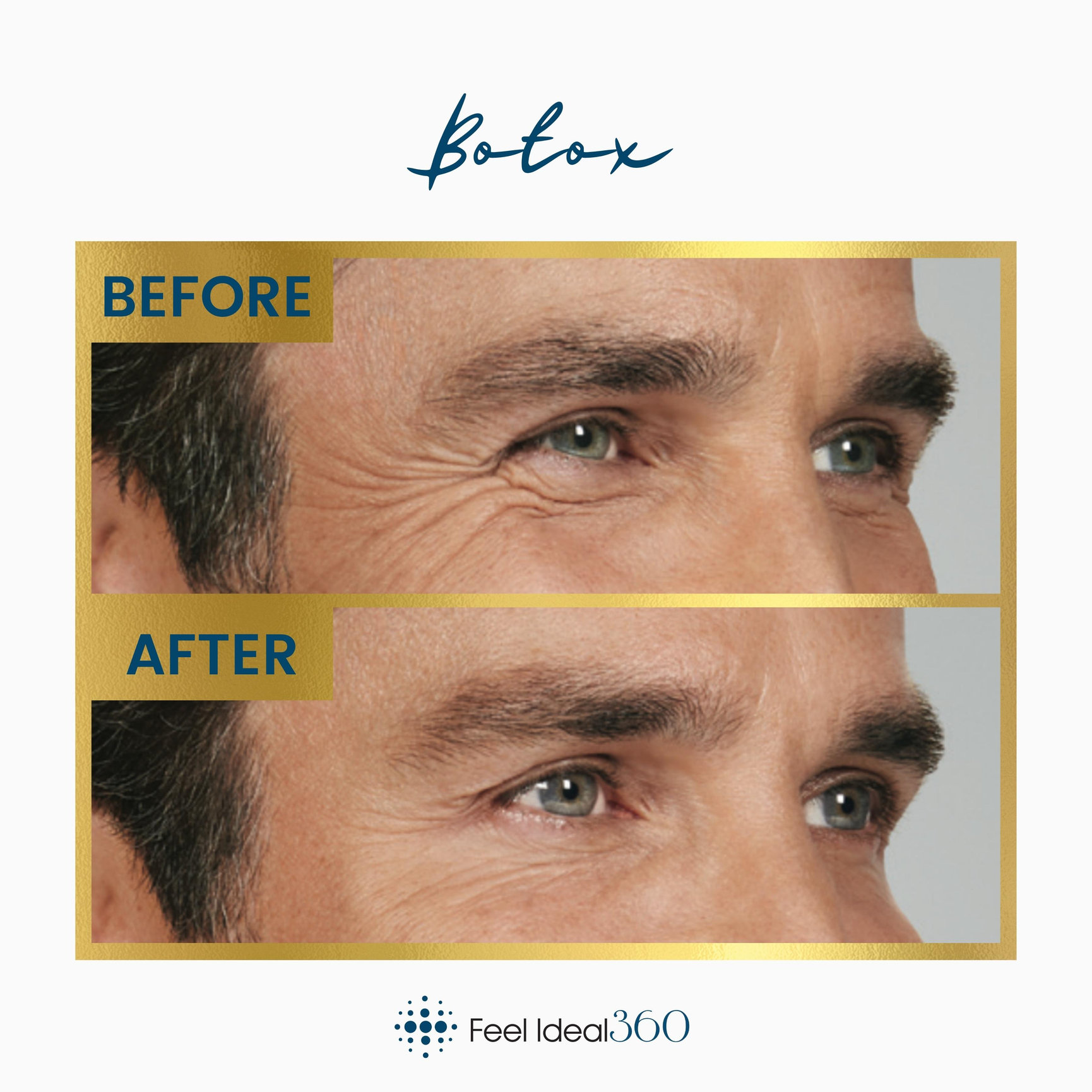 Botox Injections Before And After - Feel Ideal 360 Med Spa - Southlake, TX