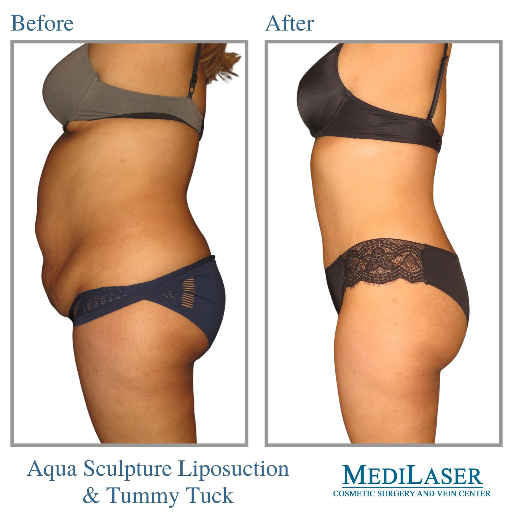 Aqua Sculpture Liposuction and Tummy Tuck Before and After - Medilaser  Surgery and Vein Center