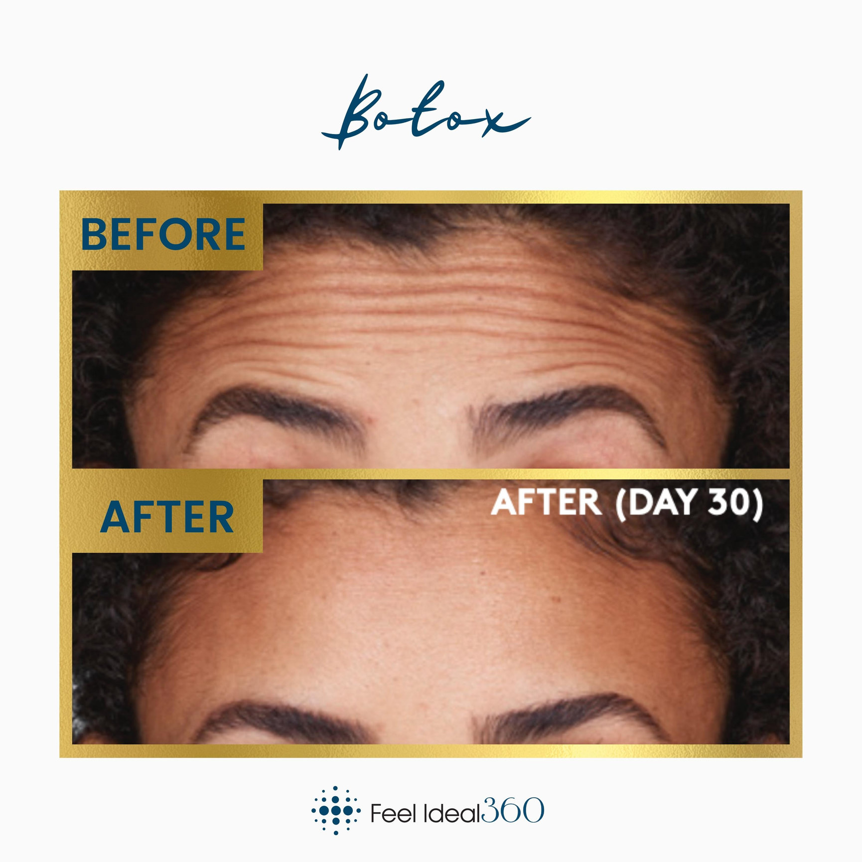 Botox Before And After Feel Ideal 360 Med Spa Southlake Tx