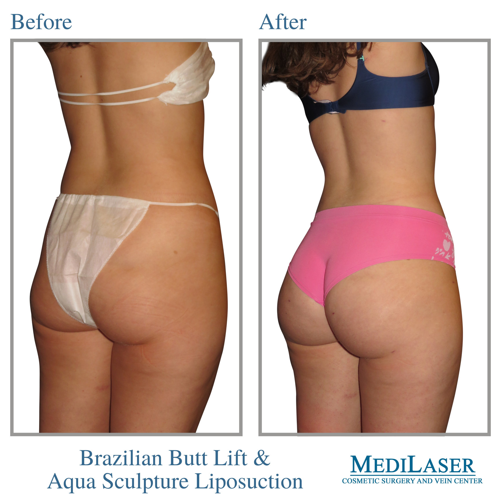 Brazilian Butt Lift Before and After - Medilaser Surgery and Vein Center